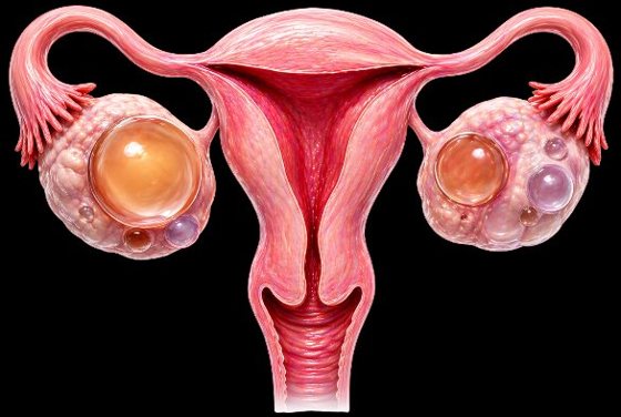Cyst