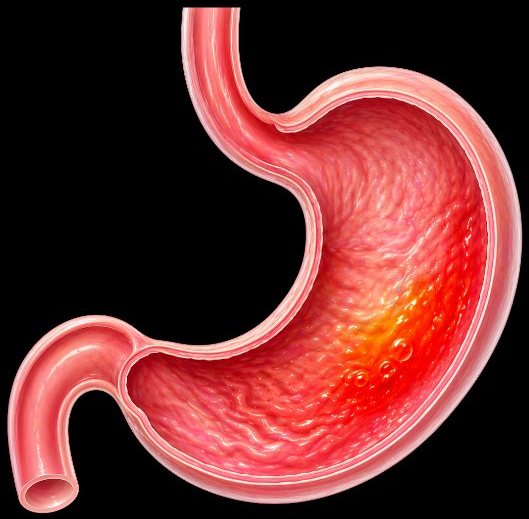 Gastrik